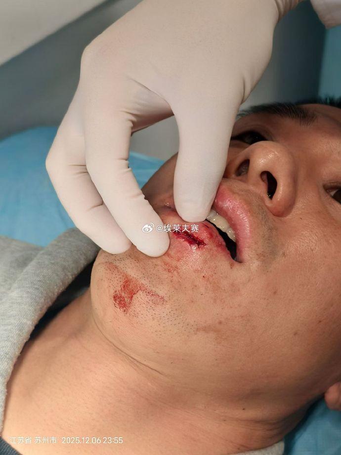 记者:王刚伤情比想象中好,侯森缝了20多针坐火车返京